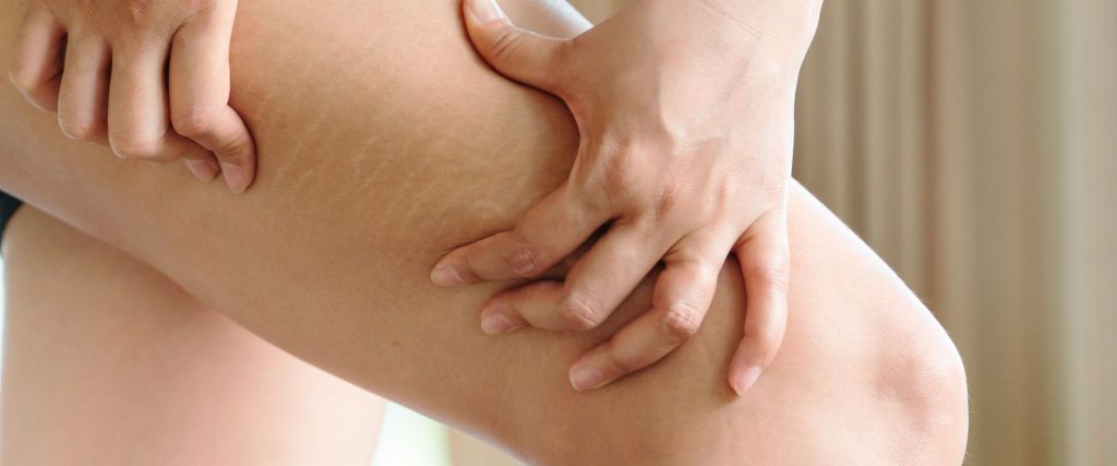 A pele é naturalmente elástica, permitindo que se estique e encolha conforme o crescimento do indivíduo. No entanto, distensões rápidas e excessivas da pele podem causar lesões conhecidas como estrias.